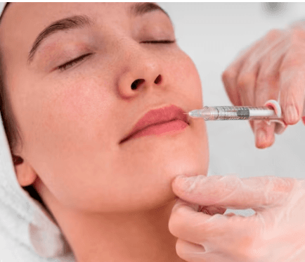 Preenchimento Labial com Ácido Hialurônico